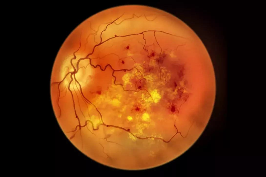 Qual relação do Diabetes com a Retina ?