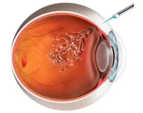 Como é feito o tratamento para a Degeneração Macular relacionada a Idade ?