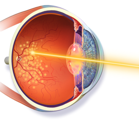 Como é feito o procedimento de Fotocoagulação a laser na Retina ?