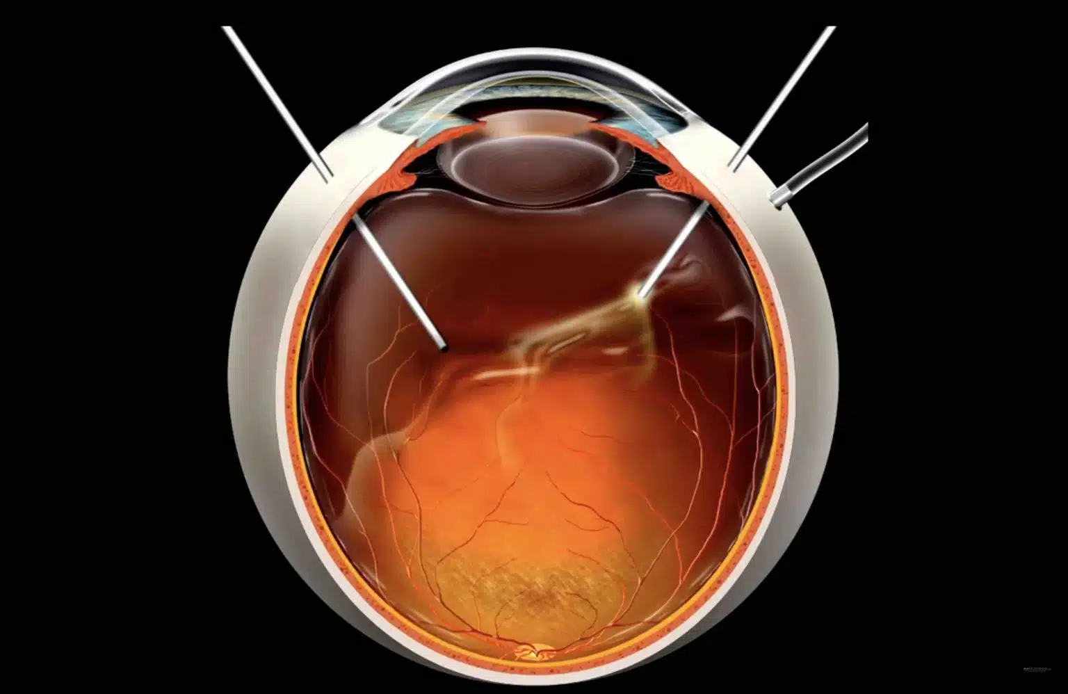 Como é realizada a cirurgia para Descolamento de Retina ?