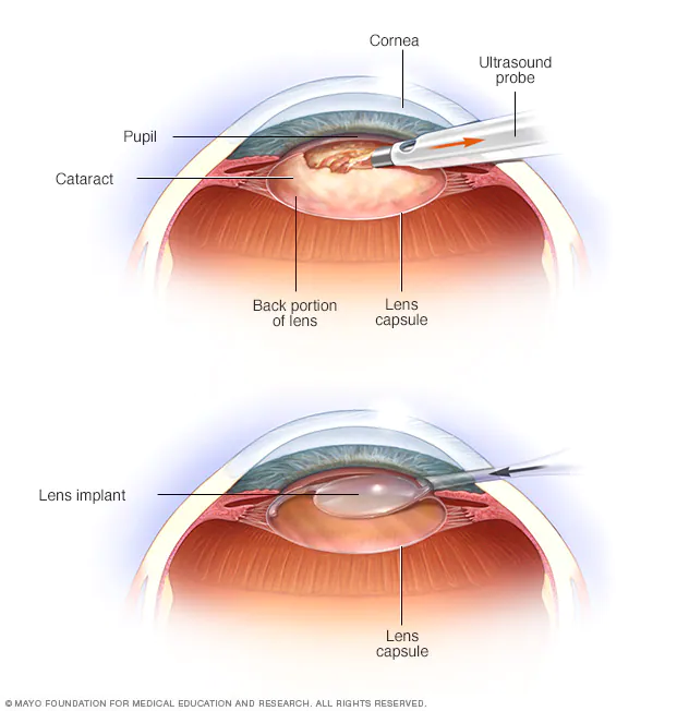 Quais são os cuidados pós-operatórios da cirurgia de Catarata ?