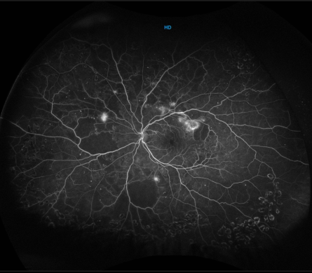 Você conhece o exame de Angiofluoresceinografia da Retina (Retinografia Fluorescente) ?